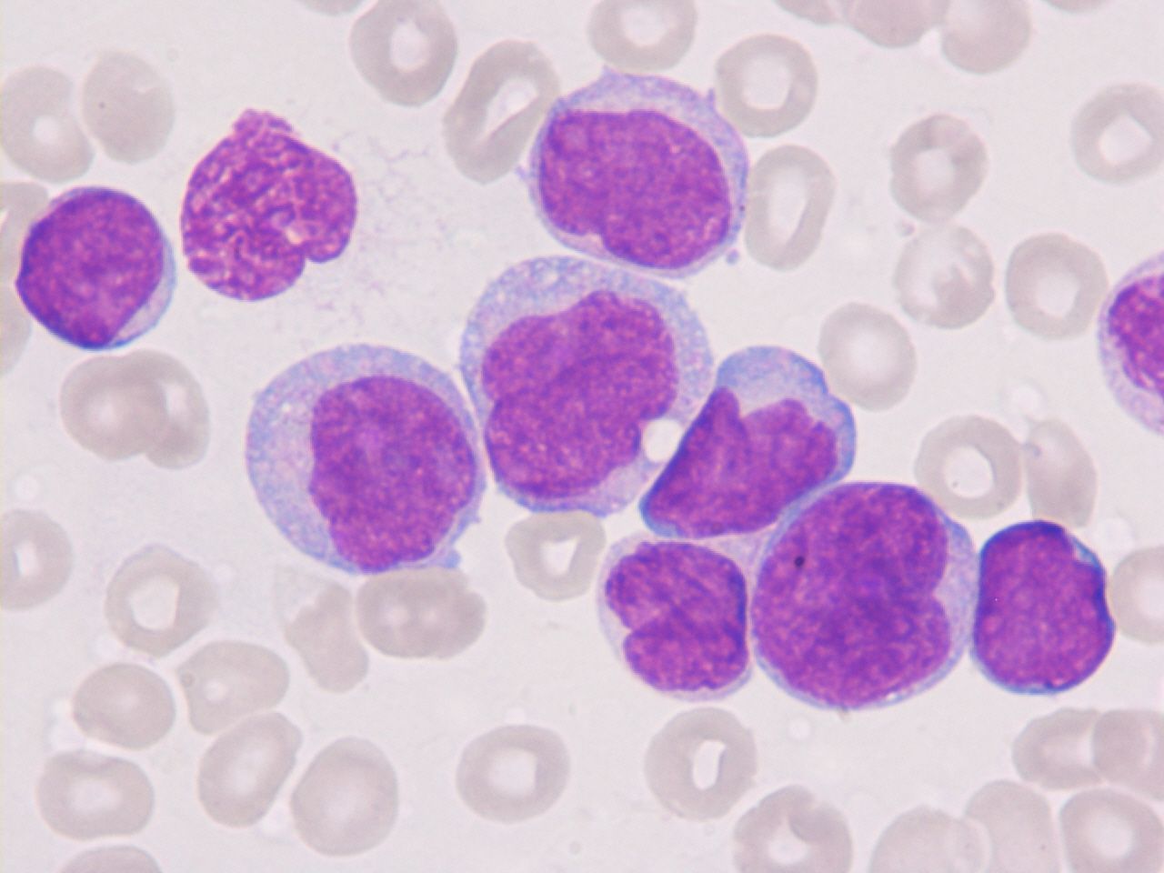 Acute myeloid leukaemia with t (9;11)(p22;q23) with complex karyotype